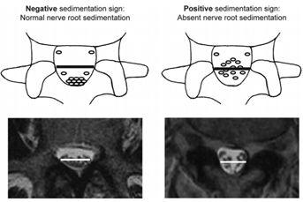 马尾神经沉降征，一个评价腰椎管狭窄的新指标