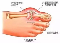 【老倪膏药】：老倪祖三贴这痛风穴位贴法