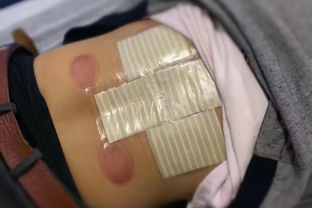 老倪祖三贴腰部规范贴敷实操步骤